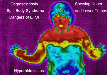 Corposcindosis or Split Body Syndrome